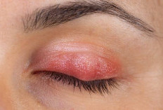 Cara Mengobati Benjolan di Kelopak Mata: Bintitan atau Kalazion? Ini Solusi Aman di Rumah