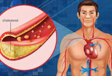 5 Pilihan Obat untuk Penderita Kolesterol Tinggi