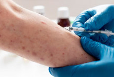 Virus Monkeypox Ancam Dunia, WHO Umumkan Cacar Monyet Status Darurat Kesehatan Global