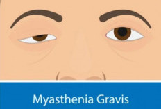 Gejalanya Sering Dianggap Remeh, Ternyata Myasthenia Gravis Bisa Berujung Kematian Jika Terlambat Ditangani