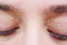 Tanda-tanda Kolesterol Tinggi Bisa Dilihat dari Mata dan Wajah 