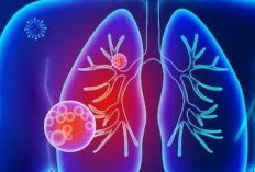 Pneumonia Bisa Memberat Karena Kurang Istirahat, Waspadai Gejalanya