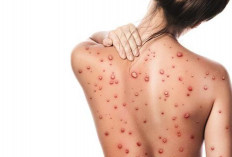 Waspada Monkeypox atau Cacar Monyet, Ikuti Cara Pencegahannya
