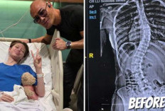 Nada Tarina Pamer Bekas Jahitan Operasi Skoliosis