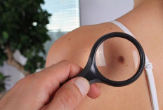 Cara Alami Menghilangkan Daging Tumbuh di Kulit dengan Aman dan Efektif