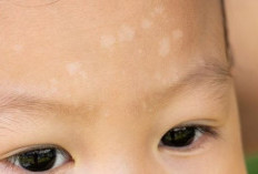 Apakah Bercak Putih pada Kulit Bayi Berbahaya? Ini Penyebab dan Cara Mengatasinya 