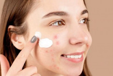 Tips Memilih Rangkaian Skincare untuk Kulit Berjerawat