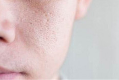 Ini 5 Kandungan Skincare yang Ampuh Mengecilkan Pori-Pori, Apa Saja?