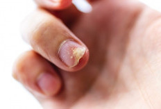 Penyebab Kuku Rusak dan Cara Mengobatinya, Kenali Gejalanya Sejak Dini