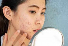 Mengenal Acne Vulgaris, Ketahui Jenis, Penyebab, dan Cara Tepat Atasi Jerawat 
