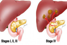 Apa Itu Kanker Pankreas? Ini Gejala dan Pengobatan Terbaru Dengan Whipple Sergery