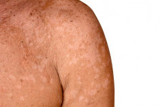 Kenali Panu: Penyebab, Cara Mengobati, dan Tips Mencegah Agar Tidak Kambuh