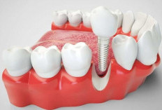 Mengenal Manfaat Implan Gigi, Solusi Atasi Gigi Ompong