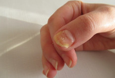 Kuku Kuning: Penyebab, Cara Mengatasi, dan Kondisi Medis yang Perlu Diwaspadai