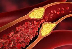 Ketahui Perbedaan Kolesterol dan Asam Urat