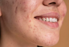 10 Langkah Perawatan Efektif untuk Kulit Berjerawat