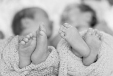Bayi Kembar Siam Lahir di RSUD Kuala Tungkal, Perlu Penanganan Khusus