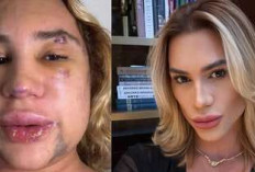 Influencer Brasil Meninggal Dunia Usai Alami Komplikasi Serius Setelah Prosedur Kecantikan