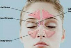 5 Bahan Alami Ampuh Redakan Sinusitis