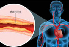 Panduan Lengkap Tanda-tanda Kolesterol Tinggi saat Berpuasa dan Cara Mencegahnya