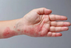 3 Cara Ampuh Mengatasi Scabies Pada Kulit