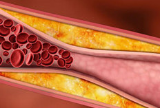 Kenali Tanda-Tanda Kolesterol Tinggi