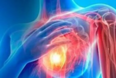 Deteksi Dini Jadi Kunci Kesembuhan Kanker Payudara, Ini Kata Dokter Spesialis Bedah Umum Onkologi