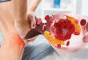 3 Bahan Alami untuk Redakan Asam Urat