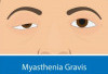 Gejalanya Sering Dianggap Remeh, Ternyata Myasthenia Gravis Bisa Berujung Kematian Jika Terlambat Ditangani