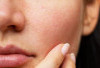 Penyebab Pori-pori Wajah yang Tersumbat agar Kulit Tetap Sehat