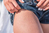 Kenali Penyebab dan Cara Mengatasi Stretch Mark