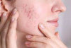 Jerawat Tak Berkutik dengan 3 Obat Alami