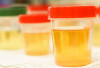 Macam-macam 6 Warna Urine yang Bisa Jadi Tanda Kondisi Kesehatan
